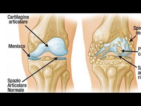 Massaggio da osteocondrosi Cheboksary Frattura del gomito che deve essere fatto