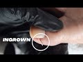 DIY INGROWN TOENAIL PEDICURE AT HOME Relaxing Pedicure