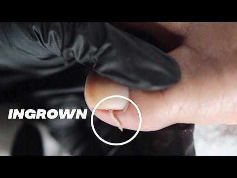 DIY INGROWN TOENAIL PEDICURE AT HOME //  Relaxing Pedicure