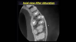 Obturation of an isthmus between the MB I and MB II canal in a maxillary molar.