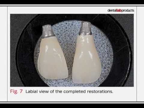 Bench Mastery: Fabricate an Esthetic Implant-Supported PFM Restoration