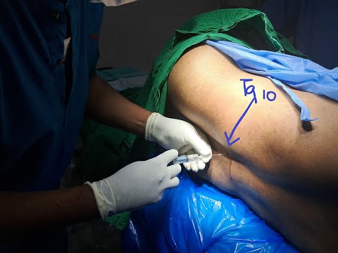 Segmental thoracic spinal anaesthesia | Dr.S.Parthasarathy MD., DNB, PhD