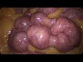 Intestinal Peristalsis