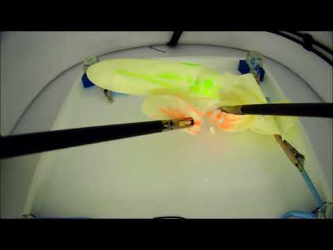 Laparoskopska apendektomija