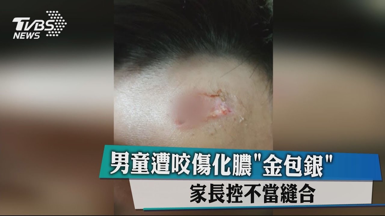 男童遭咬傷化膿「金包銀」 家長控不當縫合