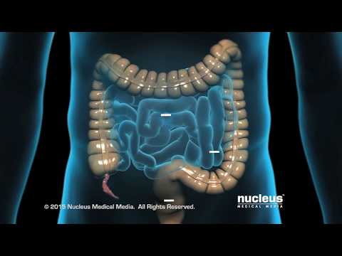 Appendicitis and appendectomy procedure at Cook Children’s