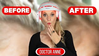 Does the CurrentBody LED Hair Growth Helmet Really Work? Doctor Anne’s 6-Month Review