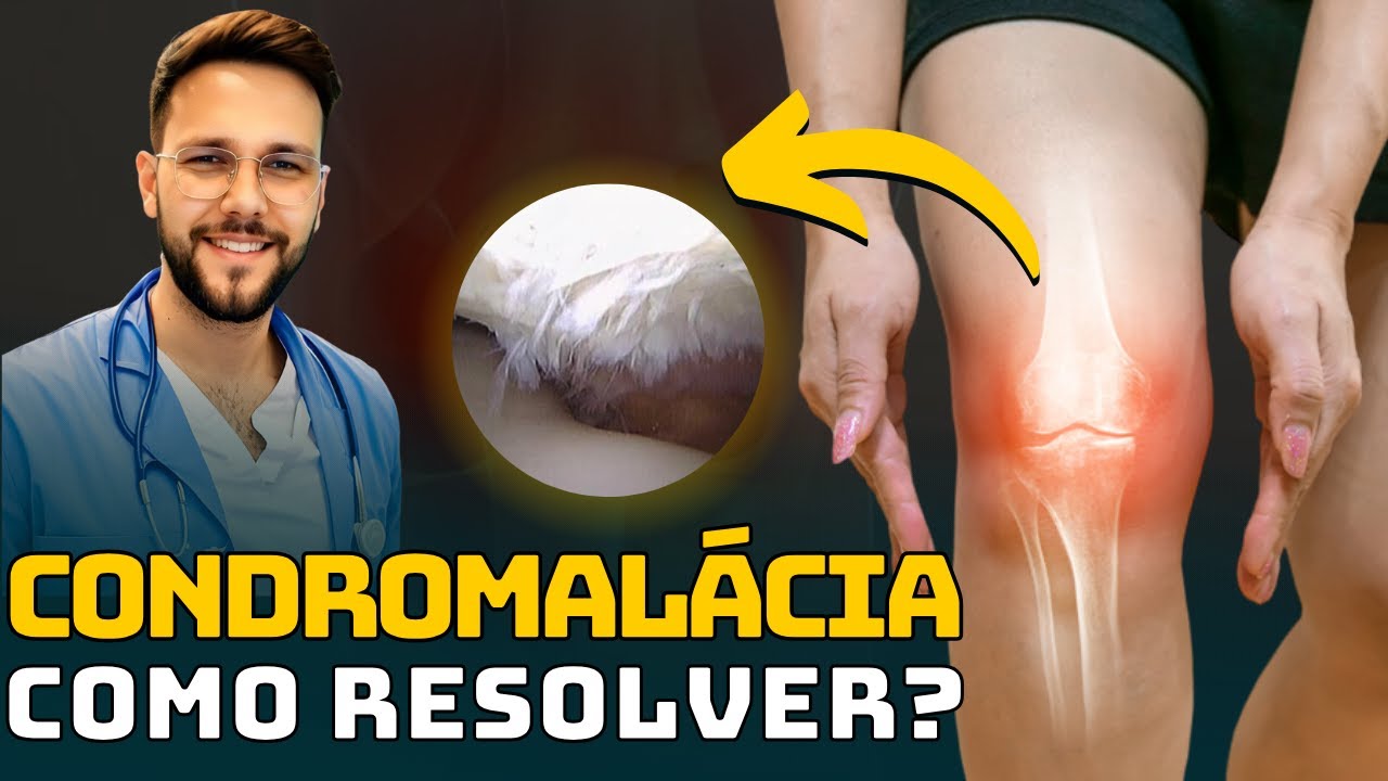 COMO CURAR A CONDROMALÁCIA PATELAR? Exercícios para alívio da dor no joelho