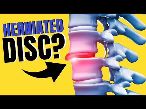 Wonder if you have a Herniated Disc?? Try this One Simple Test.