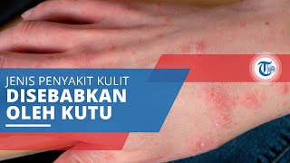Scabies, Jenis Penyakit Kulit yang Dapat Menyerang Hewan dan Manusia Disebabkan oleh Adanya Kutu