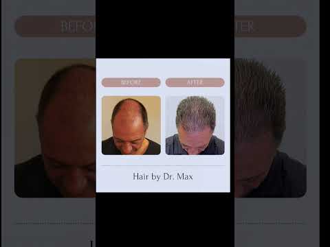 Before and after hair restoration results.