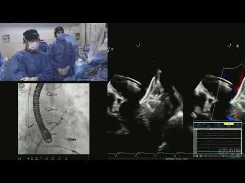 LIVE CASE 9 - Left Atrial Appendage Closure using Amplatzer Amulet