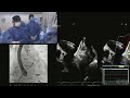 LIVE CASE 9 Left Atrial Appendage Closure Using Amplatzer Amulet