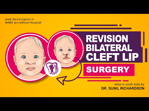 Revision Bilateral Cleft Lip Surgery Repair