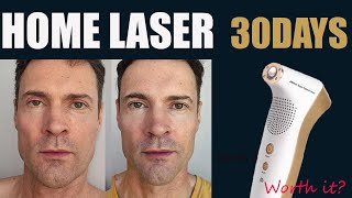 I Tried a Clinic Laser at Home and Here’s What Happened!