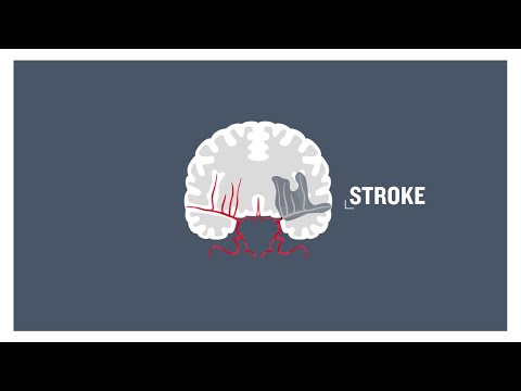 Stroke, clogged arteries and atherosclerosis