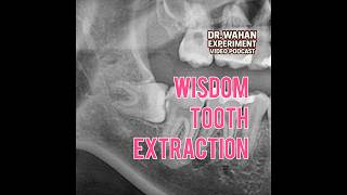 Sideways Wisdom Tooth Extraction