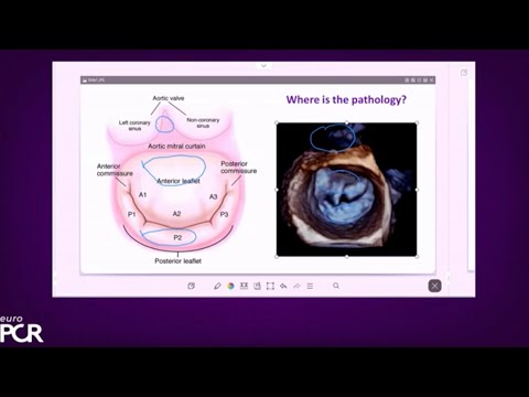 Treating diverse mitral regurgitation anatomies: the power of versatility - EuroPCR 2023