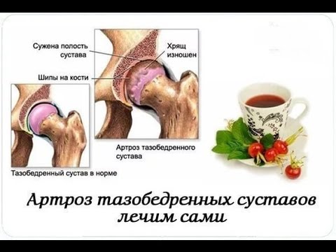 Воспаление диета при суставов Операция замена коленного сустава киев цена