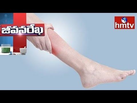 Medicina folclorică tratamentul piciorului varicos Medicina tradițională cu ulcerul la picioare