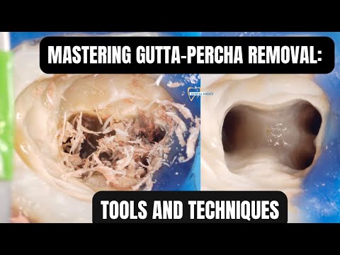 Clinical Tips for easy Gutta-Percha Removal | Endodontic Retreatment
