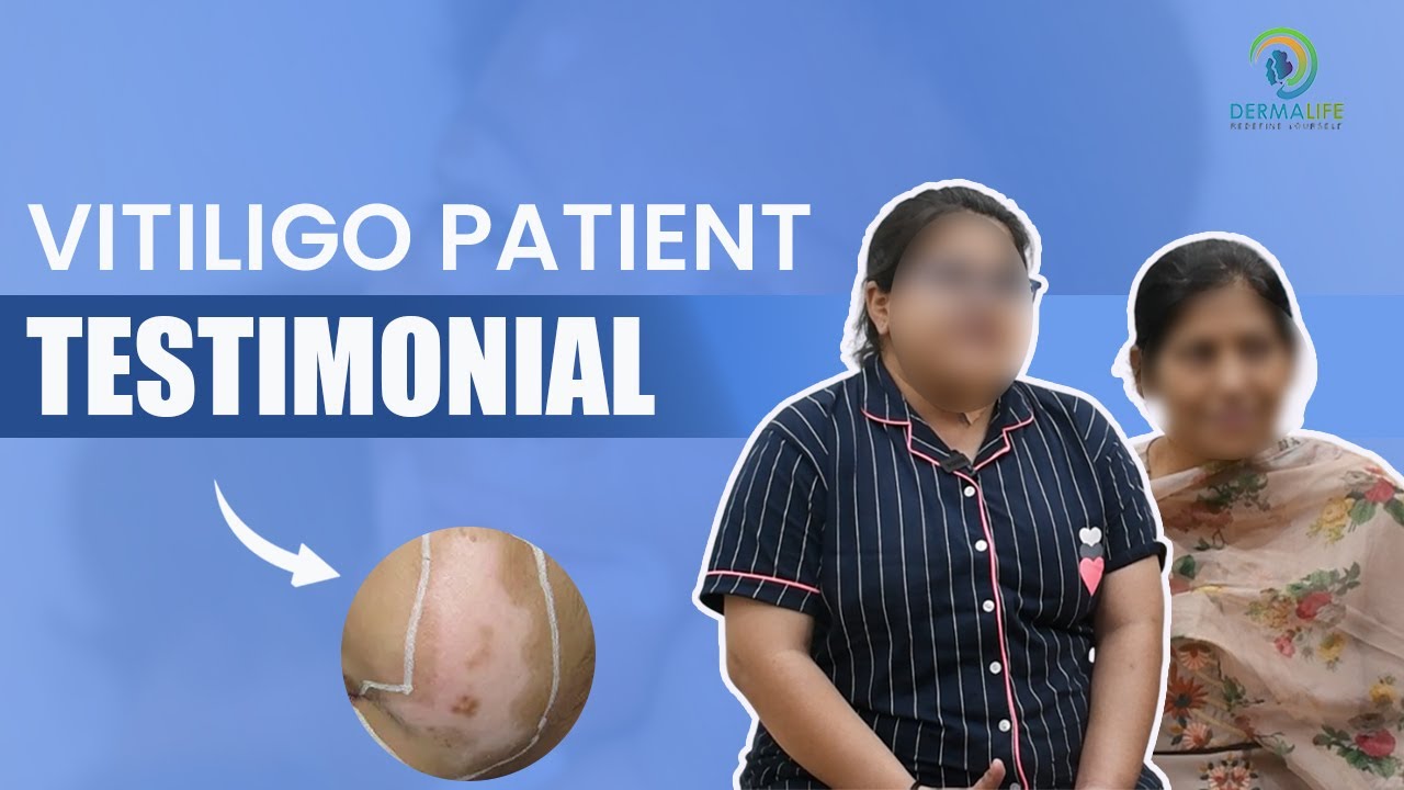 Vitiligo Treatment Testimonial/Reviews | Patient Testimonial After Vitiligo Treatment