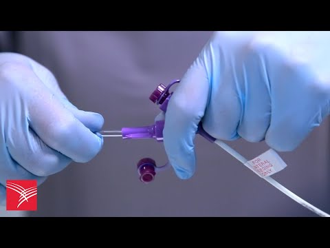 Best Practices for Connecting Kangaroo™ Nasogastric Feeding Tubes with Y-Ports