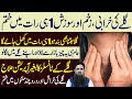 Gale Ki Kharash Ka Ilaj Gale Ke Tonsils Ka Gharelu Ilaj Gale Ki Sujan Dr Sharafat Ali