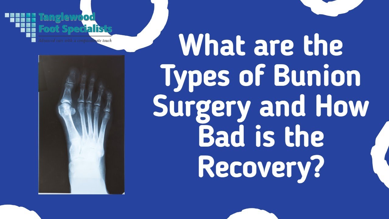 What are the Types of Bunion Surgery and How Bad is the Recovery?