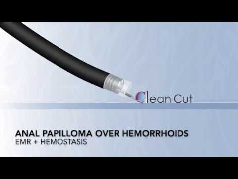 Colonoscopy: Anal Papilloma Over Hemorrhoids - Endoscopic Resection