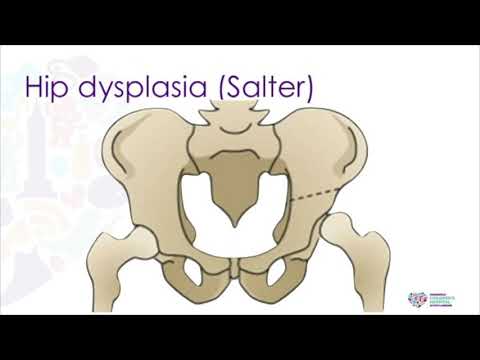 Pediatric Hip - ABOS Orthopedic Surgery Board Exam Review