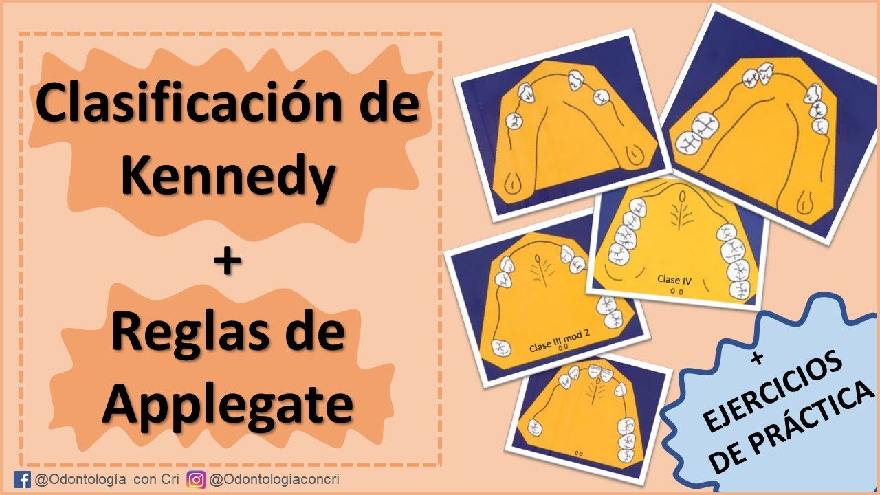 Explicación clasificación de Kennedy 2021 | Reglas de Applegate | Con ejercicios de práctica