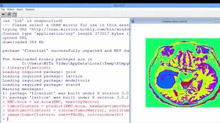 6.4.8 R6. Segmenting Images - Video 6: Detecting Tumors