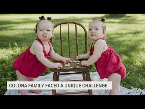 Iowa doctor treats Colona twins born with club feet without surgery