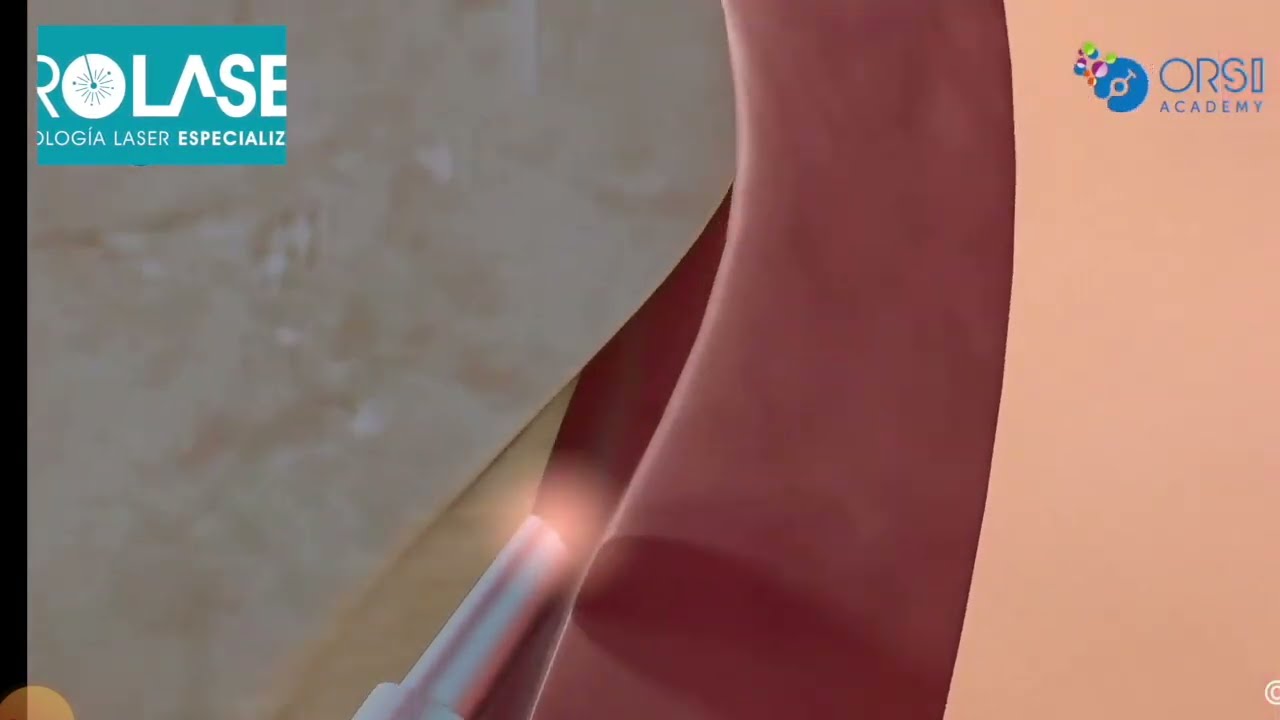 Cómo funciona el HoLEP — Animación explicativa Uroláser Chile