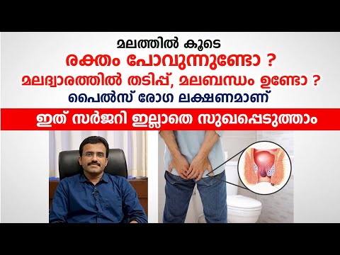പൈൽസ് സർജറി കൂടാതെ 1 ദിവസം കൊണ്ട് നീക്കം ചെയ്യാം | Piles Treatment Without Surgery | Arogyam