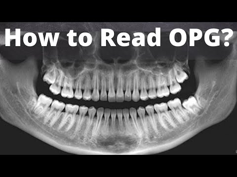 How to read Dental #orthopantomogram (OPG) Anatomical Landmarks, Indication || Oral radiology