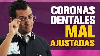¿CORONA dental MAL PUESTA ¿Como identifico que una CORONA DENTAL está MAL AJUSTADA o MAL HECHA