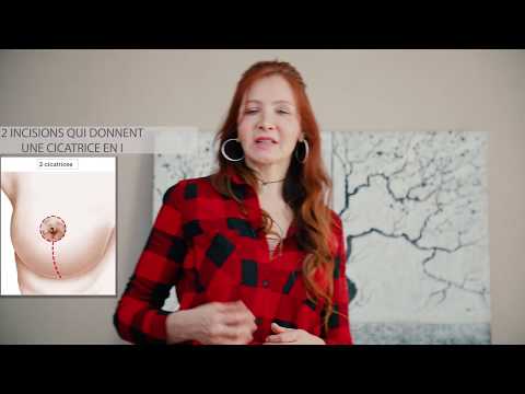 download lagu mp3 mp4 Ptose Mammaire, download lagu Ptose Mammaire gratis, unduh video klip Ptose Mammaire