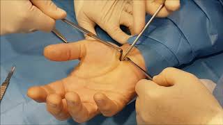 Sindrome del Tunnel Carpale: Trattamento Chirurgico con mini accesso - Dott. Maurizio Rubino