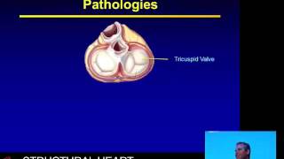 Major tricuspid valve pathologies – Prof David Celemajer