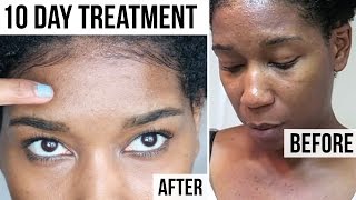 10 DAY TREATMENT for Tiny Forehead + Itchy Chest Acne Bumps