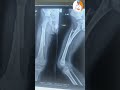 Even The Cracked Bones Of Children Get Joined Easily Shorts