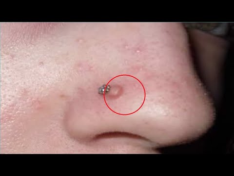 how to get rid of nose piercing bump with toothpaste