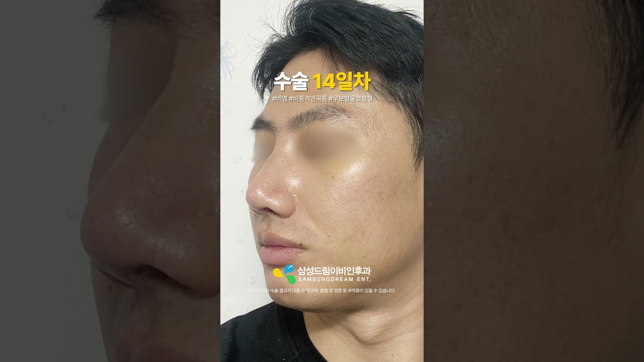 남자 무보형물 코성형 한 달 후기🤞 #shorts #비염수술 #비중격만곡증수술 #무보형물 #남자코성형 #코성형브이로그 #코성형후기 #코성형전후 #비염 #비중격 #무보형물코성형