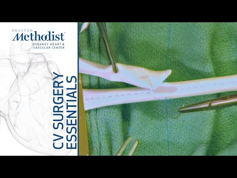 End to Side Anastomosis (Eric K. Peden, MD, M. Mujeeb Zubair, MD)