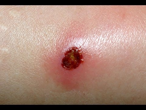 Periarthritis Kniegelenk ICD Kissen für zervikale kaufen degenerativen Bandscheibenerkrankungen