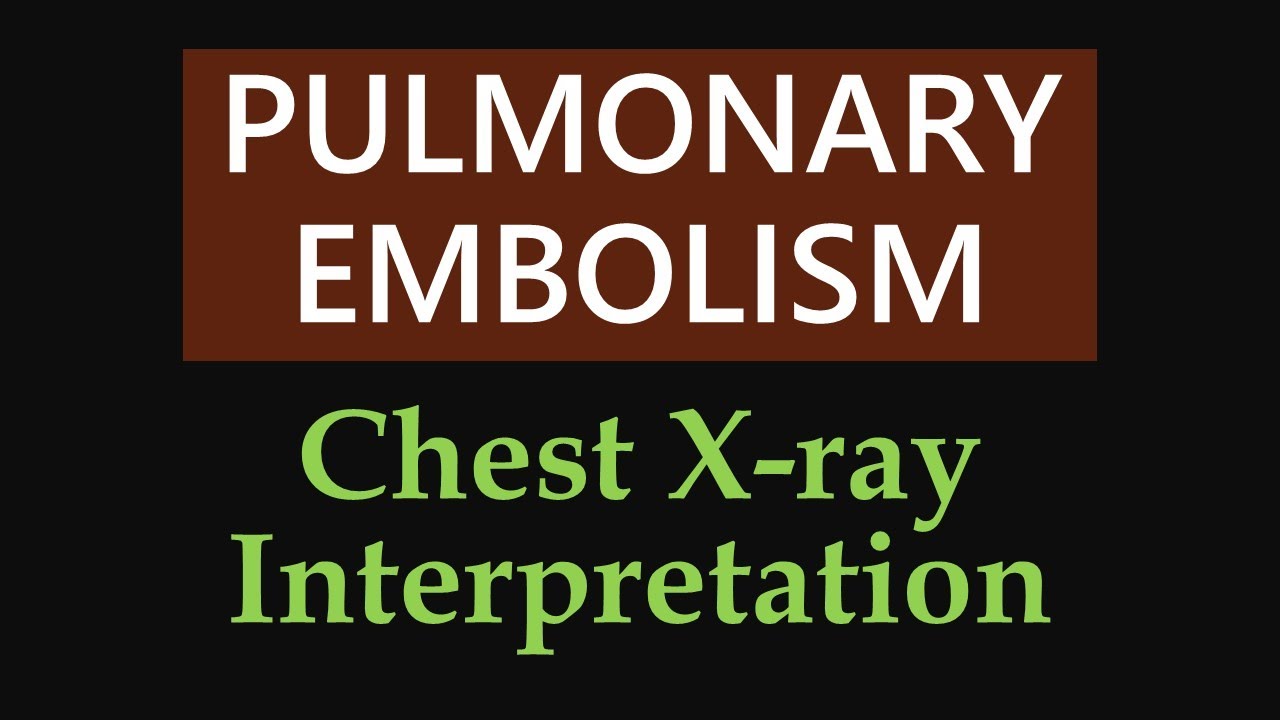 Pulmonary Embolism : Chest X-ray Interpretation