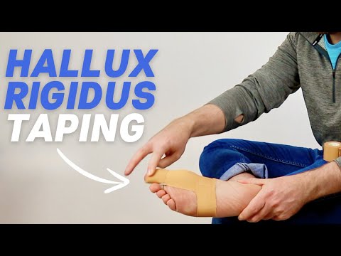 Hallux Rigidus Taping | Big Toe Arthritis Taping