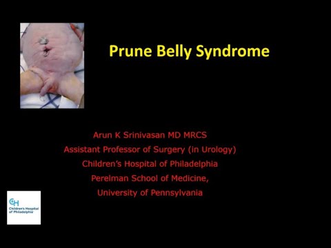 5.14.2020 Urology COViD Didactics - Prune Belly Syndrome